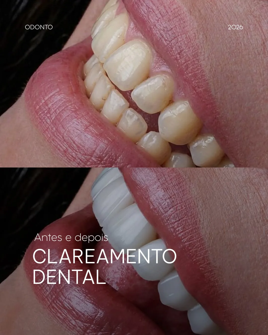 Antes e depois de um clareamento dental: dentes amarelados em cima e brancos embaixo