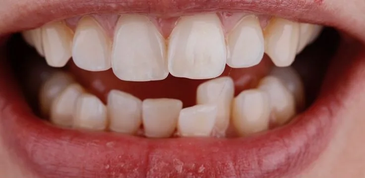 Antes: dentes inferiores desalinhados e com tons diferentes