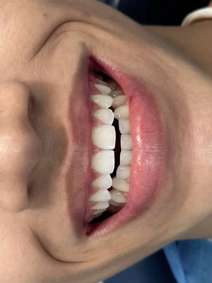Sorriso aberto com lentes de contato dental